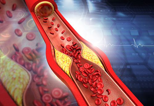 Clogged arteries, Cholesterol plaque in artery.